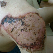 Abrasion of the shoulder (fall from a bicycle): 1. day